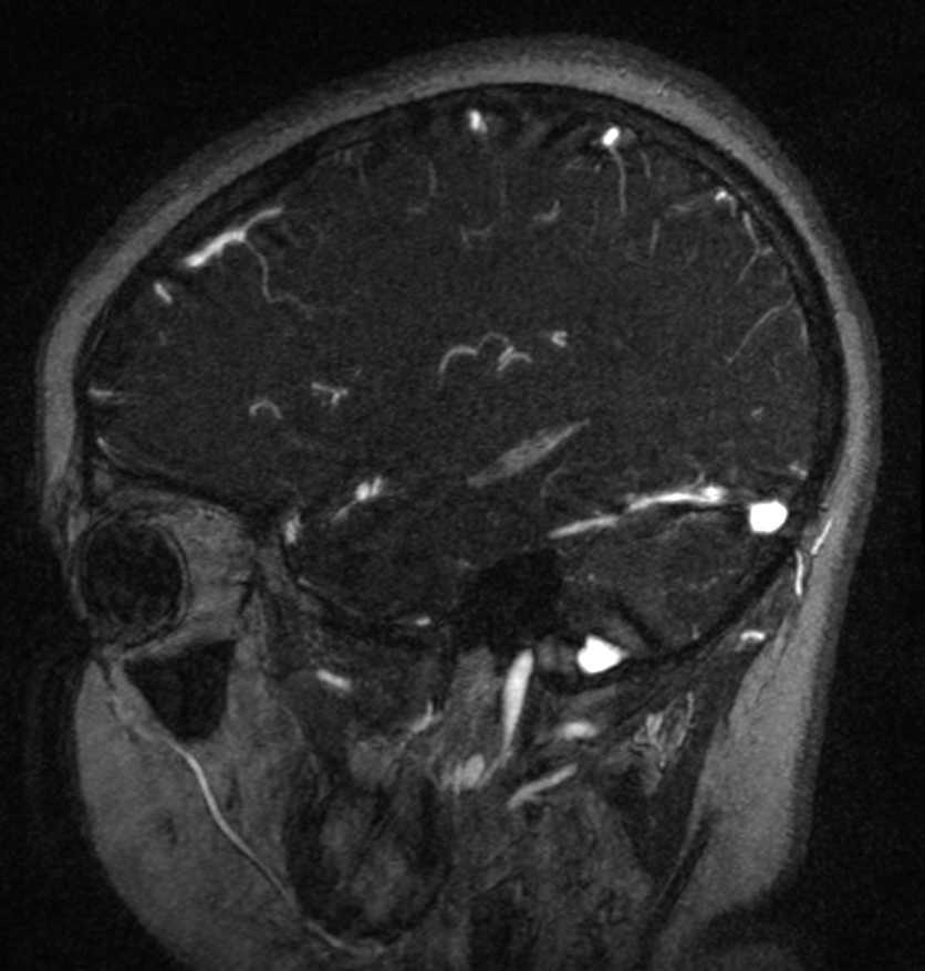 Normal brain MRI and venogram (Radiopaedia 39554-41862 Sagittal MRV 17).jpg