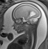Normal brain fetal MRI - 22 weeks (Radiopaedia 50623-56050 Sagittal T2 Haste 10).jpg