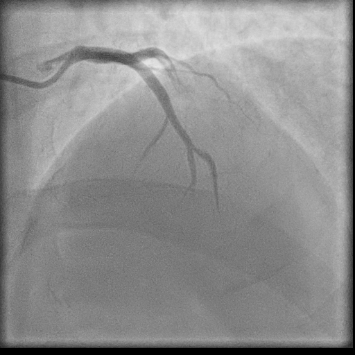 Normal coronary angiogram (DSA) (Radiopaedia 63081-71571 E 18).jpg