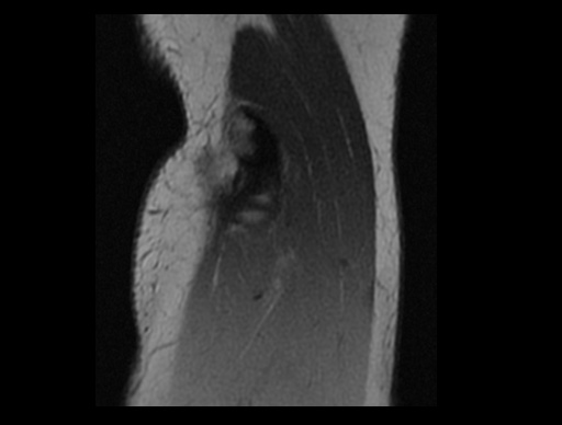 File:Normal elbow arthrograms (Radiopaedia 75550-86805 Sagittal PD 10).jpg