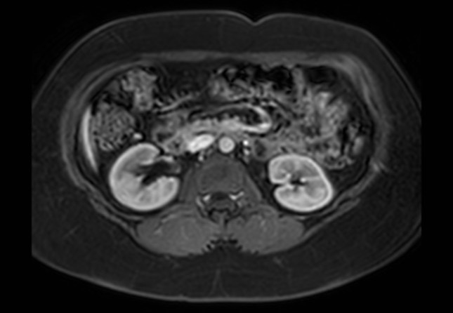 Normal liver MRI with Gadolinium (Radiopaedia 58913-66163 J 18).jpg