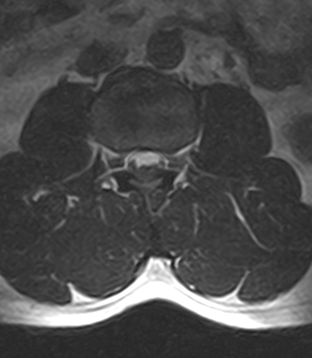 Normal lumbar spine MRI - low-field MRI scanner (Radiopaedia 40976-43699 Axial T2 43).jpg