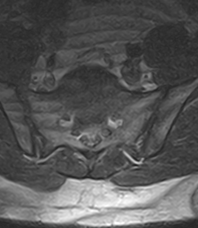 Normal lumbar spine MRI - low-field MRI scanner (Radiopaedia 40976-43699 Axial T2 95).jpg