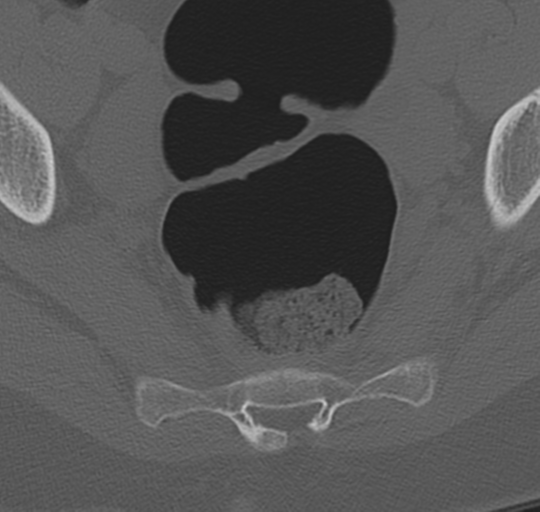 File:Normal lumbosacral CT (Radiopaedia 37923-39867 Axial bone window 100).png