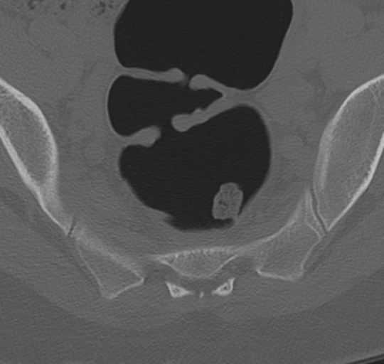 File:Normal lumbosacral CT (Radiopaedia 37923-39867 Axial bone window 96).png