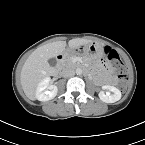 File:Normal multiphase CT liver (Radiopaedia 38026-39996 C 36).jpg