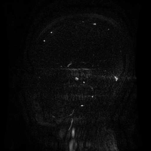 Normal noncontrast MR venography (Radiopaedia 87578-103957 A 59).jpg