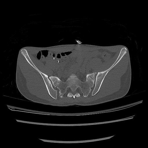 Normal pelvis CT (Radiopaedia 51471-57236 Axial bone window 33).jpg