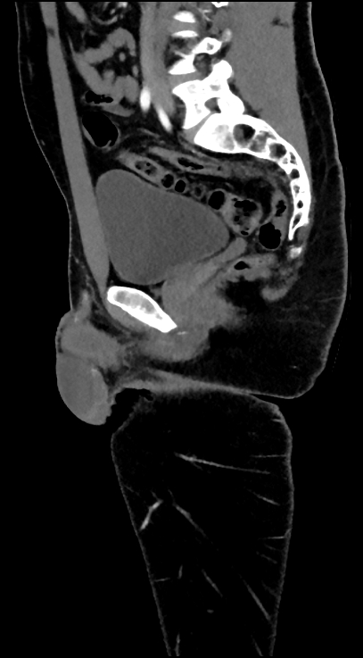 Normal pelvis CT angiogram (Radiopaedia 84966-100481 C 50).jpg