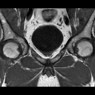File:Normal prostate (MRI) (Radiopaedia 29986-30535 Coronal T1 5).jpg