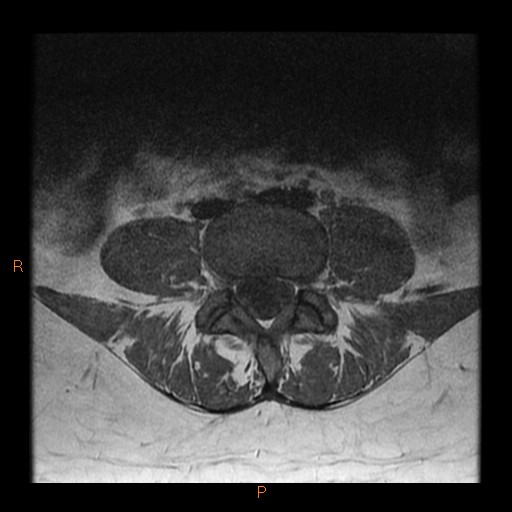 File:Normal spine MRI (Radiopaedia 77323-89408 Axial T1 16).jpg