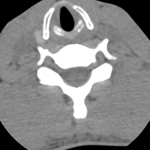 Normal trauma cervical spine (Radiopaedia 41017-43760 Axial non-contrast 42).png