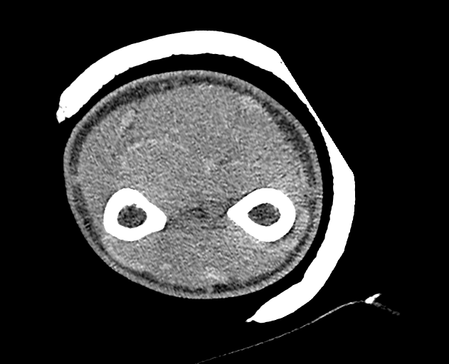 Normal wrist CT (Radiopaedia 41425-44297 Axial non-contrast 61).png