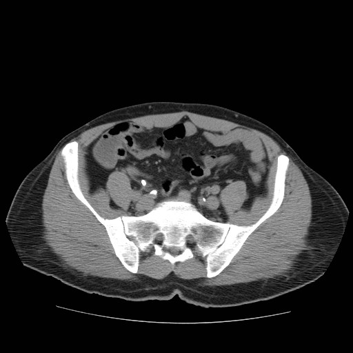 File:Obstructed kidney with perinephric urinoma (Radiopaedia 26889-27067 Axial non-contrast 34).jpg