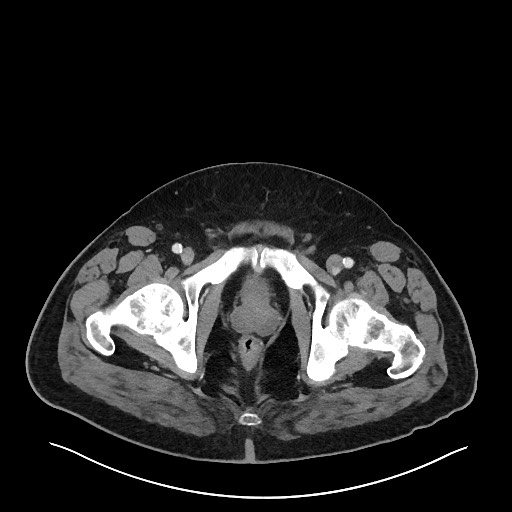 Obstructing sigmoid adenocarcinoma (Radiopaedia 58465-65619 A 159).jpg
