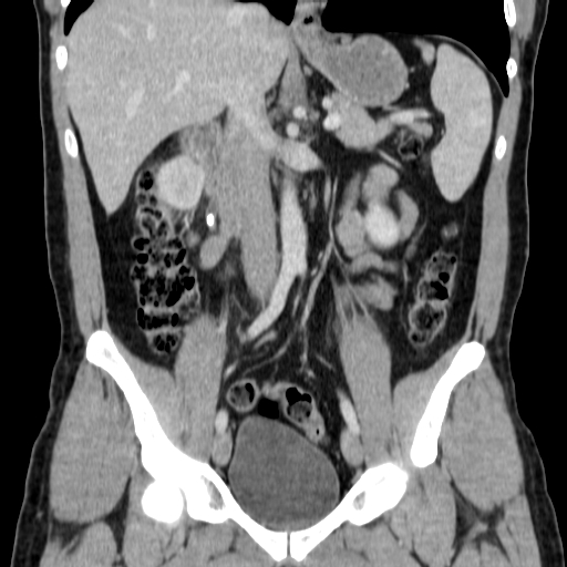 File:Obstructing ureteric calculus (Radiopaedia 18615-18514 C 38).jpg