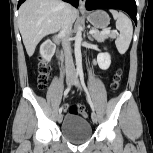 File:Obstructing ureteric calculus (Radiopaedia 18615-18514 C 40).jpg