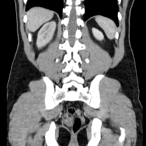 File:Obstructing ureteric calculus (Radiopaedia 18615-18514 C 61).jpg