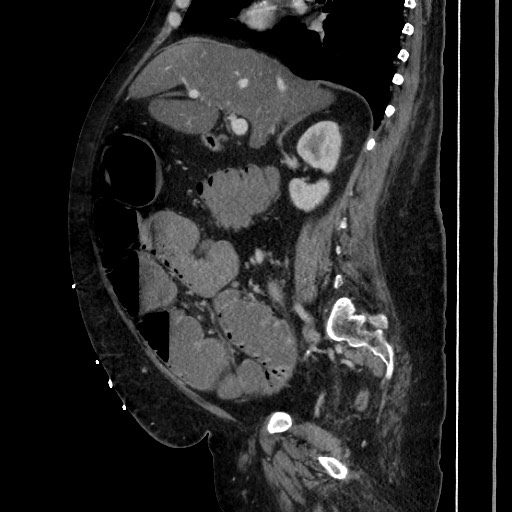 Obstructive colonic diverticular stricture (Radiopaedia 81085-94675 C 103).jpg