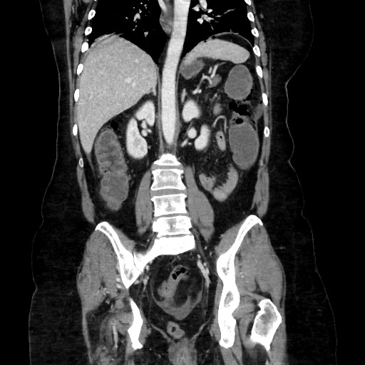 Obstructive distal colonic adenocarcinoma causing cecal perforation (Radiopaedia 86830-102989 C 115).jpg