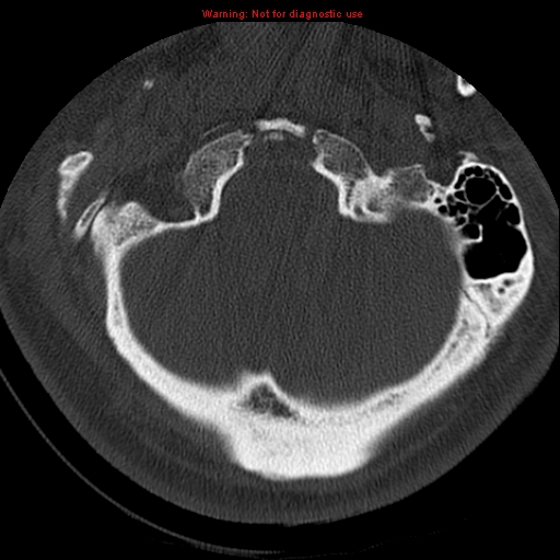File:Occipital condyle fracture (Radiopaedia 18366-18208 Axial bone window 10).jpg