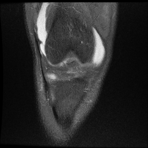 File:ACL acute full thickness tear - deep lateral femoral sulcus sign (Radiopaedia 38594-40740 Coronal PD fat sat 6).jpg