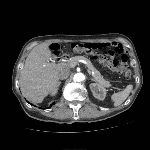 Abdominal aortic aneurysm (Radiopaedia 13341-13340 Axial C+ arterial phase 53).jpg