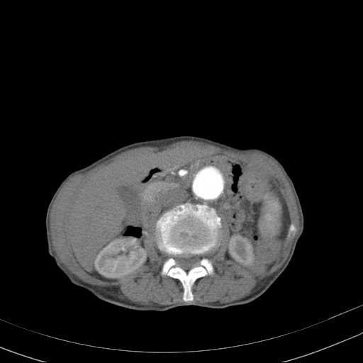 File:Abdominal aortic aneurysm (Radiopaedia 20827-20742 Axial C+ arterial phase 15).jpg