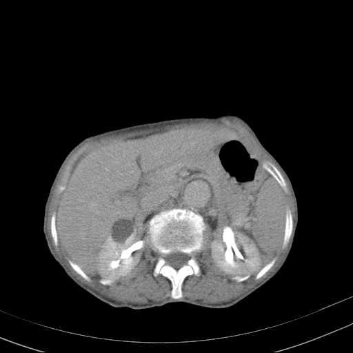 File:Abdominal aortic aneurysm (Radiopaedia 20827-20742 Axial C+ delayed 9).jpg
