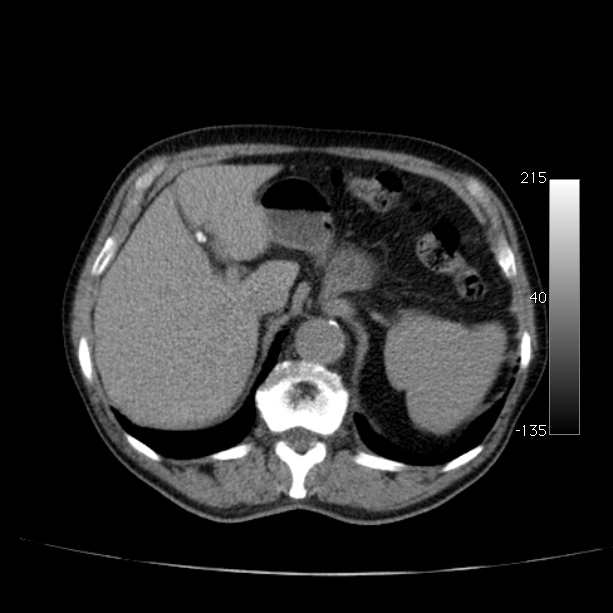 Abdominal aortic aneurysm (Radiopaedia 29248-29660 Axial non-contrast 15).jpg