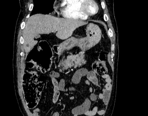Abdominal aortic aneurysm (Radiopaedia 67117-76452 Coronal C+ arterial phase 13).jpg