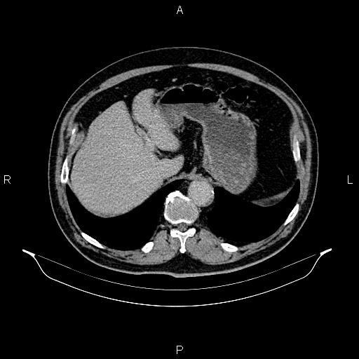 File:Abdominal aortic aneurysm (Radiopaedia 83094-97462 Axial renal excretory phase 25).jpg