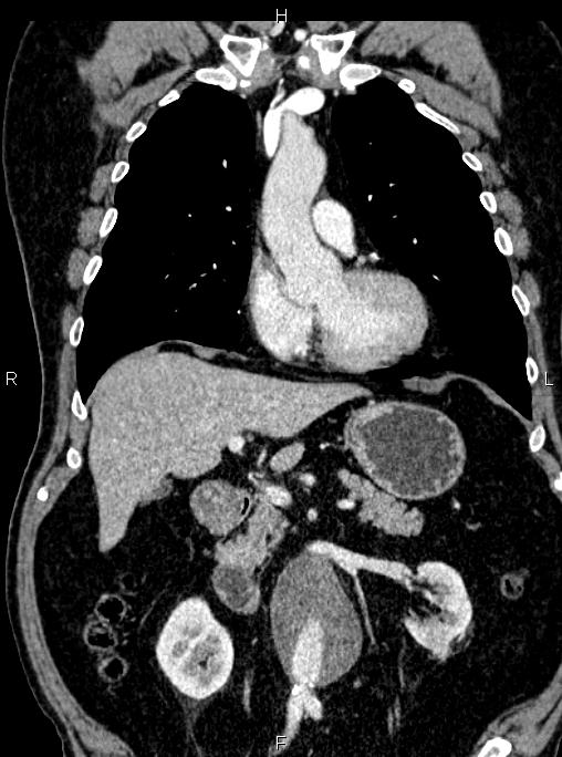 Abdominal aortic aneurysm (Radiopaedia 83094-97462 Coronal renal cortical phase 42).jpg