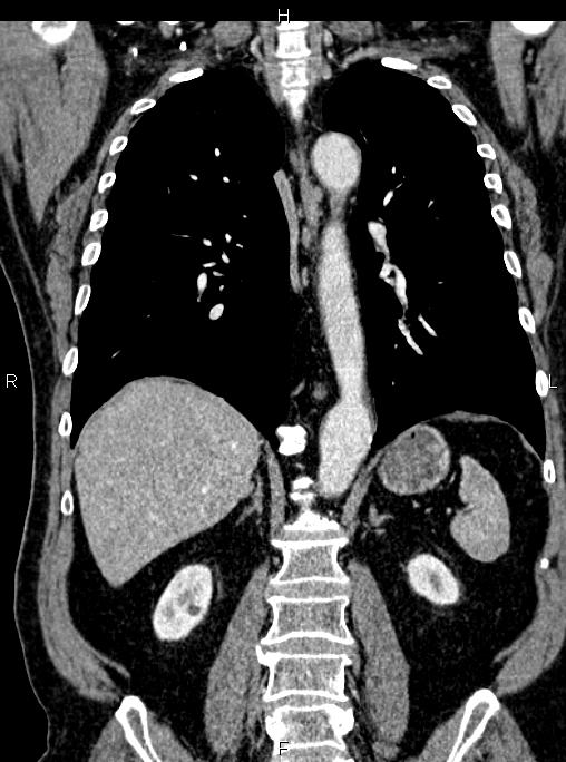 Abdominal aortic aneurysm (Radiopaedia 83094-97462 Coronal renal cortical phase 60).jpg