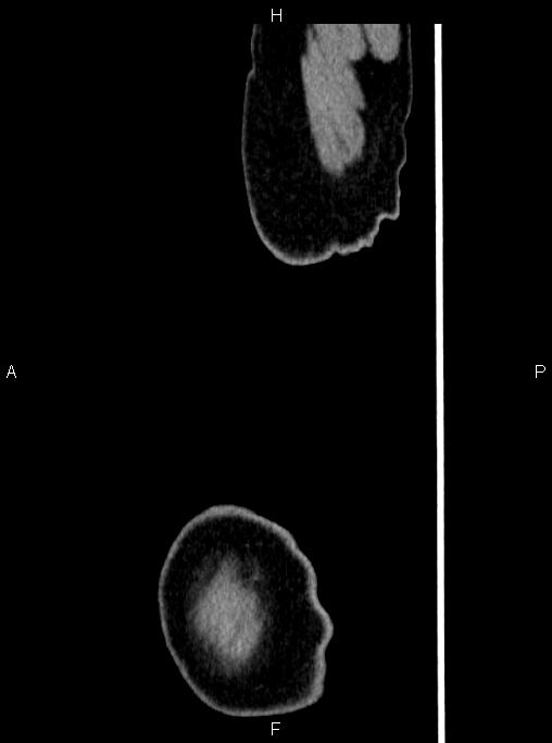 Abdominal aortic aneurysm (Radiopaedia 83094-97462 Sagittal renal cortical phase 130).jpg