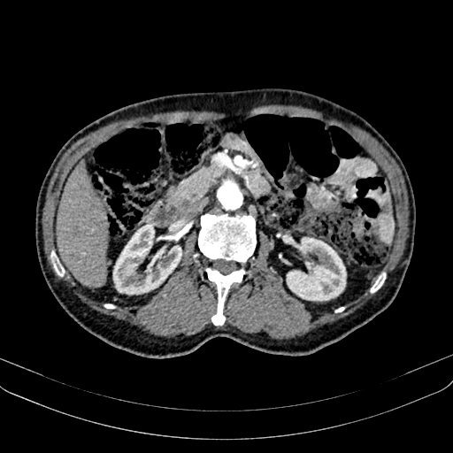 Abdominal aortic aneurysm (Radiopaedia 83581-98689 Axial C+ arterial phase 51).jpg