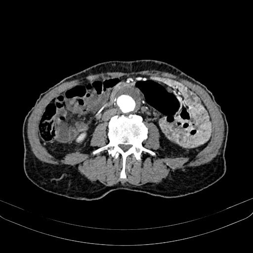 Abdominal aortic aneurysm (Radiopaedia 83581-98689 Axial C+ arterial phase 66).jpg