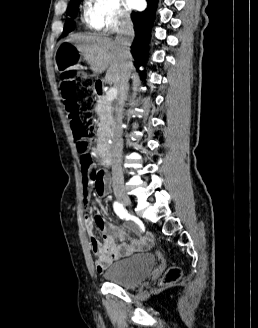 Abdominal aortic aneurysm (Radiopaedia 83581-98689 Sagittal C+ arterial phase 27).jpg