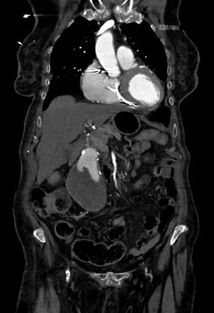 Abdominal aortic aneurysm with thrombus fissuration (Radiopaedia 73192-83919 Coronal C+ arterial phase 20).jpg