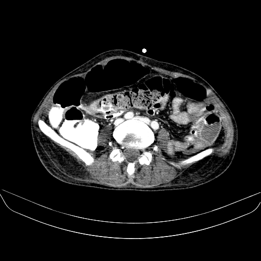 File:Abdominal collection due to previous cecal perforation (Radiopaedia 80831-94320 Axial C+ portal venous phase 126).jpg