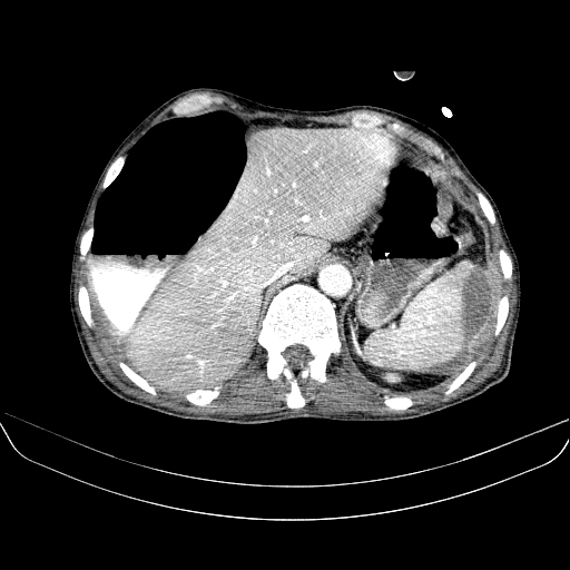 File:Abdominal collection due to previous cecal perforation (Radiopaedia 80831-94320 Axial C+ portal venous phase 40).jpg