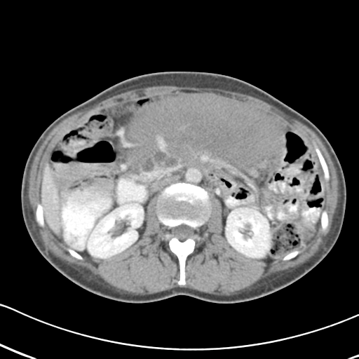 Abdominal desmoid tumor (Radiopaedia 41007-43740 Axial C+ portal venous phase 26).png