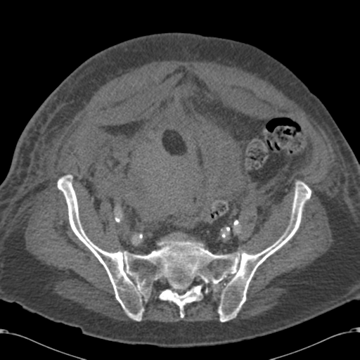 Abdominal hematoma (Radiopaedia 33614-34715 Axial C+ portal venous phase 97).png