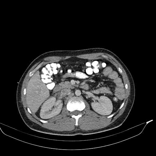 File:Abdominal multiorgan trauma (Radiopaedia 21792-21754 Axial C+ portal venous phase 19).jpg