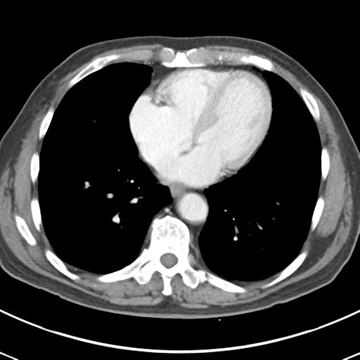 Abdominal wall metastasis from colorectal carcinoma (Radiopaedia 31016-31717 Axial C+ portal venous phase 5).jpg