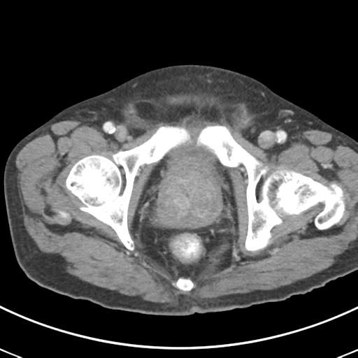 Abdominal wall metastasis from colorectal carcinoma (Radiopaedia 31016-31717 Axial C+ portal venous phase 74).jpg