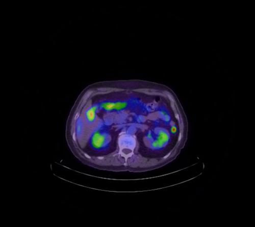 Abdominal wall metastasis from colorectal carcinoma (Radiopaedia 31016-31719 Axial 74).jpg