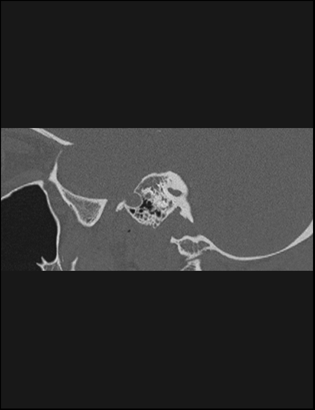 Aberrant right internal carotid artery (Radiopaedia 65191-74198 Sagittal non-contrast 69).jpg