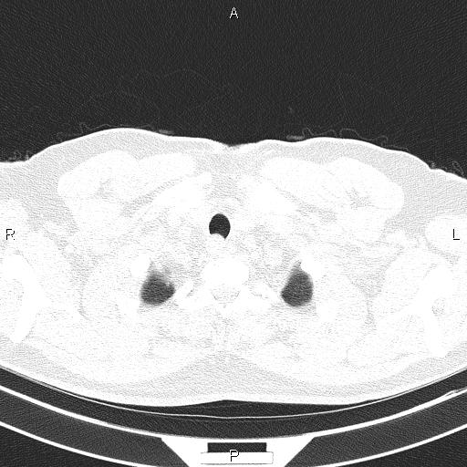 Aberrant right subclavian artery (Radiopaedia 87093-103354 Axial lung window 9).jpg