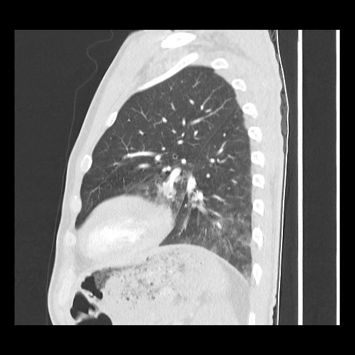 Accessory left horizontal fissure with lingular pneumonia (Radiopaedia 53763-59843 Sagittal lung window 50).jpg